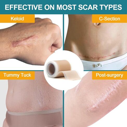 Silicone Scar Sheets for face, Silicone Scar Tape, Removal Strips for Surgical Scars 1.5" x 79" Medical Grade Silicone Scar Tape for C-Section, Tummy Tuck, Keloid (1 Roll 1.5" x 79") in Saudi Arabia
