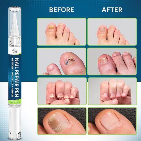 مجموعة معالجة فطريات أظافر القدم بقوة إضافية - نقع القدم، قلم إصلاح الأظافر وبلسم شجرة الشاي - مجموعة العناية بالقدم، حل رائع للقدم ذات الرائحة الكريهة، قدم الرياضي، الأظافر المتشققة والفطرية المتغيرة اللون - صنع في الولايات المتحدة الأمريكية in Kuwait