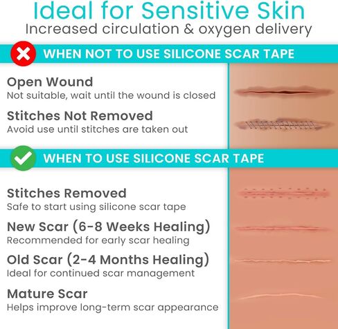 ViveCare Silicone Scar Sheet Tape for Surgical Scars - Medical Grade Silicone Scar Patches for After Surgery - Silicone Bandage Gel Healing Tape Strips - for Scars, C Section (Beige) in Kuwait