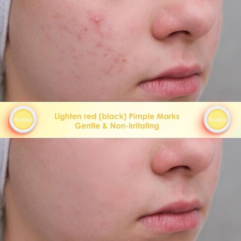 تصحيح بثرة AUSLKA ، التصحيح البارز ، بقع Zit Hydrocolloid Red LED ، النقاط الموضعية للبليميش ، 6 عبوات ، استخدم 6-8 ساعات (أصفر ، يقلل من علامات البالة الحمراء والأسود) in Kuwait