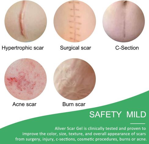 إزالة صفائح الندبات المصنوعة من السيليكون الاحترافية، علاج علامات التمدد الجراحية، حروق حب الشباب، قسم الجدرة C، والمزيد من رقع الندبات، الندبات القديمة والجديدة، رقع الندبات القابلة لإعادة الاستخدام، 3 × 1.6 × 4 (كمية تكفي 60 يومًا) in Kuwait