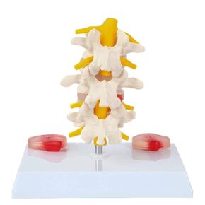 Axis Scientific Lumbar Vertebrae with Prolapsed Discs - Human Anatomy System Miniature, Scientific Anatomy Model, Demonstration Skill Educational Model, Includes Product Manual