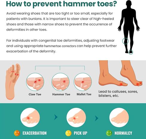 Welnove Hammertoe Corrector - Toe Straightener to Curled Toes, Broken toe, Bunion Corrector for Women and Men, Small*3 Pairs in Saudi Arabia