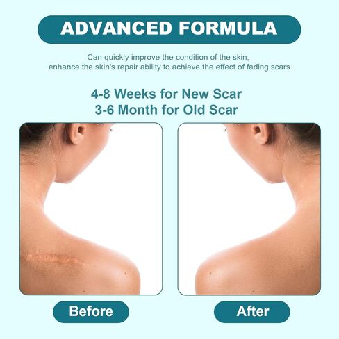 BESTEK Scar Cream, Advance Scar Gel for Surgical Scars,Face,Body,Leg, Burns, Acene,C-Section, Stretch Marks, Keloids,Scar Treatments for Old & New Scars,Scar Removal for Women Men,1.76oz/50ml in Saudi Arabia
