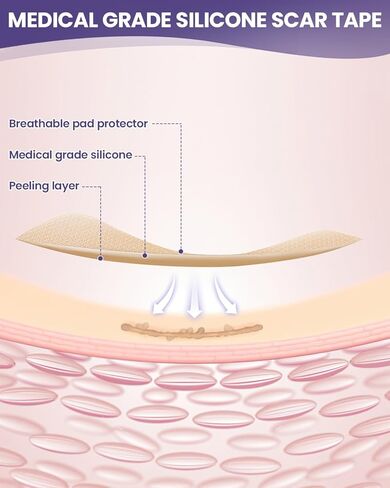 أوراق الندبات المصنوعة من السيليكون من WOOKINGWA - لفة مقاس 1.6 بوصة × 120 بوصة، شريط الندبات من الدرجة الطبية، شرائط إزالة الندبات غير المهيجة للندبات الجراحية، الجدرة، القسم C، شد البطن، الحروق، حب الشباب in Kuwait