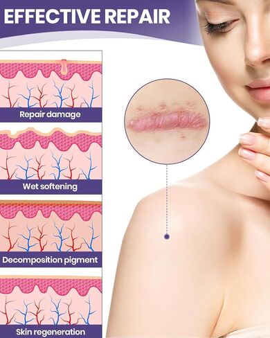 أوراق الندبات المصنوعة من السيليكون من WOOKINGWA - لفة مقاس 1.6 بوصة × 120 بوصة، شريط الندبات من الدرجة الطبية، شرائط إزالة الندبات غير المهيجة للندبات الجراحية، الجدرة، القسم C، شد البطن، الحروق، حب الشباب in Kuwait