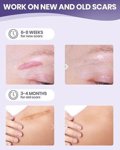 أوراق الندبات المصنوعة من السيليكون من WOOKINGWA - لفة مقاس 1.6 بوصة × 120 بوصة، شريط الندبات من الدرجة الطبية، شرائط إزالة الندبات غير المهيجة للندبات الجراحية، الجدرة، القسم C، شد البطن، الحروق، حب الشباب in Kuwait