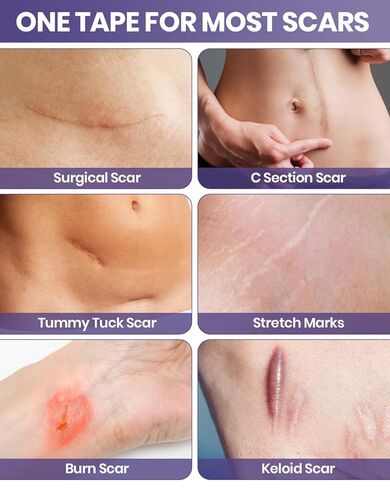 أوراق الندبات المصنوعة من السيليكون من WOOKINGWA - لفة مقاس 1.6 بوصة × 120 بوصة، شريط الندبات من الدرجة الطبية، شرائط إزالة الندبات غير المهيجة للندبات الجراحية، الجدرة، القسم C، شد البطن، الحروق، حب الشباب in Kuwait