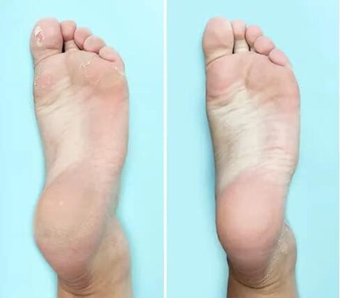 من أي وقت مضى ذرة و Callus trimmer - الإغاثة الفورية من الذرة والكالس | يزيل الجلد الجاف ، الصلب والمتصدع | علاج عناديلة المنزل لرعاية القدم in Saudi Arabia