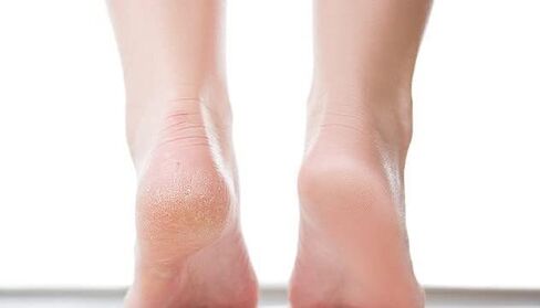 من أي وقت مضى ذرة و Callus trimmer - الإغاثة الفورية من الذرة والكالس | يزيل الجلد الجاف ، الصلب والمتصدع | علاج عناديلة المنزل لرعاية القدم in Saudi Arabia