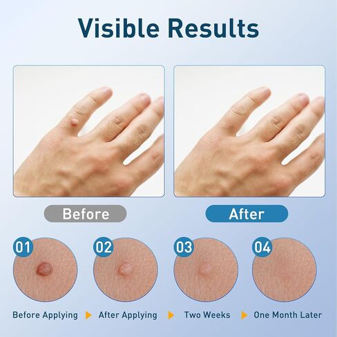 قلم RART & MOLE REAM FOR FACE & BODY - قلم مصحح علامة الجلد مع قضيب دقيق ، إزالة الثآليل الأخمصية ، صيغة عشبية طبيعية لطيفة لجميع أنواع البشرة (2) in Kuwait