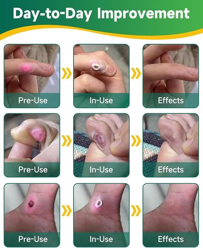 Corn Remover Pads for Feet & Toes – Professional Foot Corn Remover Kit with Removal Pads, PU Film, Remover Tool & Corn Cushions, Complete Corn Removal & Recovery Care for Hard Skin & Calluses in Saudi Arabia