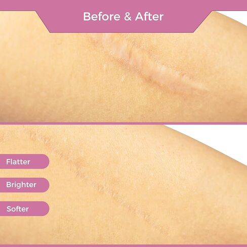 Professional Medical Silicone Scar Tape - Grade Scar Sheets, Non irritating, Painless for C-Section, Surgical Scars, Burn, Keloid, Acne, Provide Safe and Effective Solutions(1.6" x 60" Roll) in Saudi Arabia