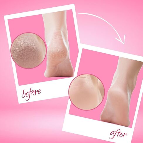 Callus Remover Gel for Feet. Strong Professional Formula Removes Tough Callus Instantly. Get Spa like Pedicures at home - 1 Fl Oz in Saudi Arabia