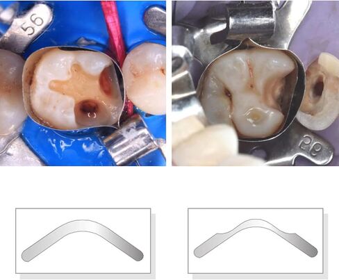 أربطة مصفوفة الأسنان Tofflemire Matrix Retainer الفولاذ المقاوم للصدأ انحناء كبير مقطعي مصفوفات محيطية أداة طب الأسنان (40 قطعة انحناء كبير) in Kuwait