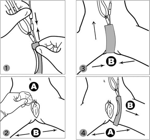 نظام جمع البول لاستخدام الإناث ، وسلس البول جامع جامع الاستشعار الحساسة غير الغازية ، القسطرة الخارجية الإناث- K12 in Kuwait