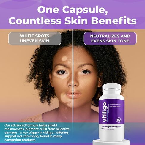 Vitiligo Capsules 60 Count | 1 Month | Improve Skin Pigmentation Support and Reduce White Spots | Effective Vitiligo Supplement | Natural Solution for White Spots on Skin. (1) in Saudi Arabia