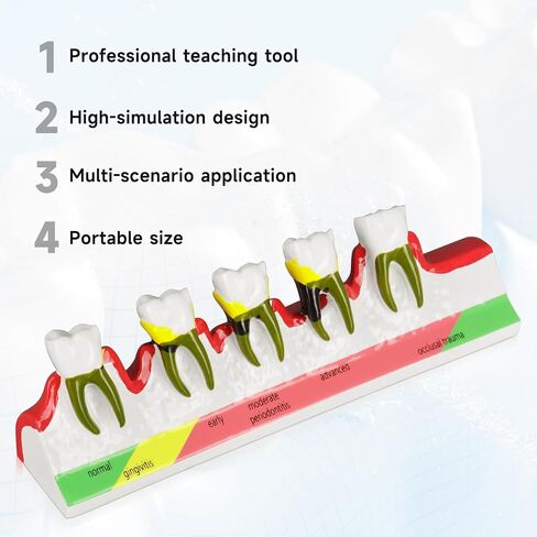 Dental Caries Developing Model, Dental Teeth Model for Dental Tooth Anatomy Study, Doctor-Patient and Oral Care Education in Kuwait