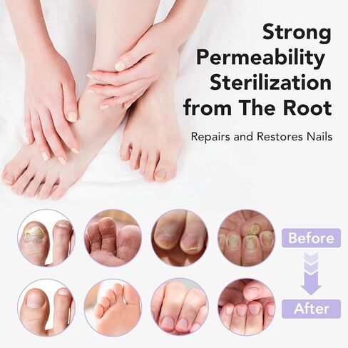 علاج الأظافر الفطري قوة إضافية ، وعلاجات أظافر الصبغة للأظافر السميكة والأصفر والمتحلل ، و 30 مل ل 4 أسابيع من الفطريات الأظافر ، وأظافر الأظافر ، والرياضيين ، ونمو الأظافر و "القويتر" in Kuwait