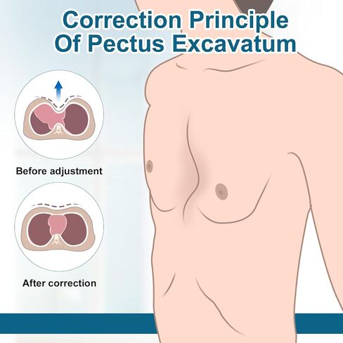 Pectus Excavatum Orthosis Brace, Pectus Excavatum Vacuum Bell, Sternal Depression Support, Thoracic Depression Brace, Sunken Sternum Splint for Adults and Child (Large) in Saudi Arabia