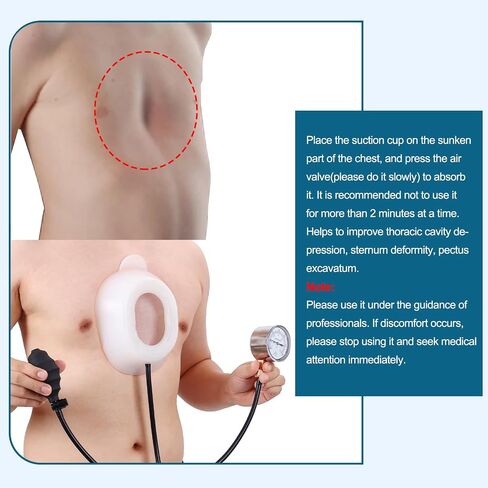 Pectus Excavatum Orthosis Brace, Pectus Excavatum Vacuum Bell, Sternal Depression Support, Thoracic Depression Brace, Sunken Sternum Splint for Adults and Child (Large) in Saudi Arabia