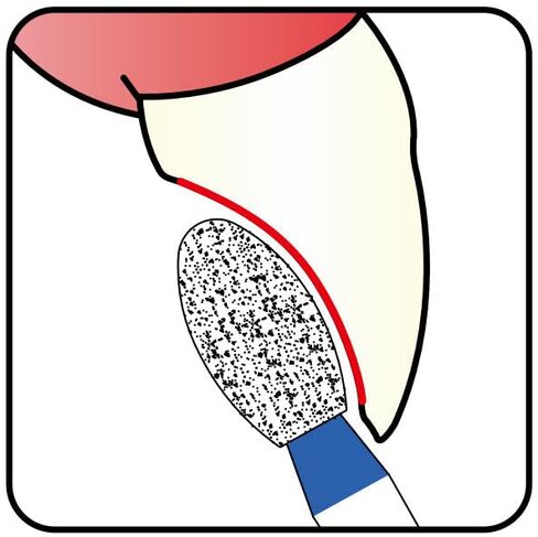 277.21F1, Egg, 2.1 mm Dia, Fine Grit Diamond Bur, 5 per Pack in Kuwait