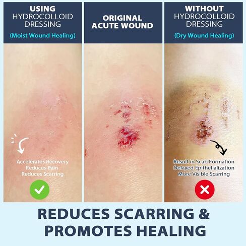 Hydrocolloid Roll Gel Bandages for Wounds: Extra Large Waterproof Hydrocolloid Patches for Wound Care, Cut-to-Size Hydrocolloid Tape (2in*16ft) in Saudi Arabia