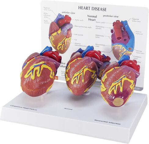 GPI Anatomicals - مجموعة نموذج القلب المصغرة المكونة من 3 قطع ، نماذج القلب الطبيعية والمرضية لتعليم التشريح وتعليم علم وظائف الأعضاء ، نموذج علم التشريح لمكتب الطبيب والفصول الدراسية ، وموارد التعلم الطبي in Kuwait