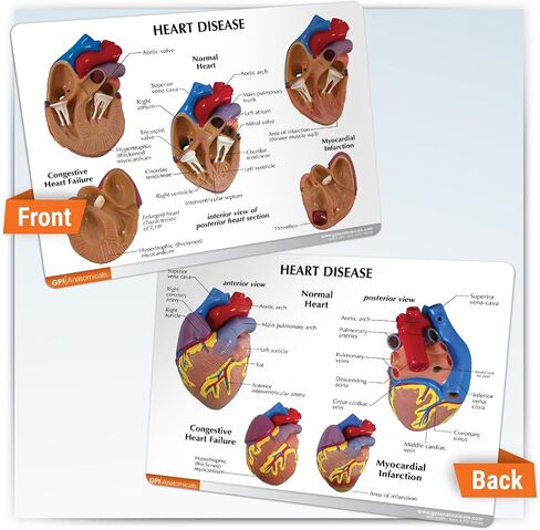 GPI Anatomicals - مجموعة نموذج القلب المصغرة المكونة من 3 قطع ، نماذج القلب الطبيعية والمرضية لتعليم التشريح وتعليم علم وظائف الأعضاء ، نموذج علم التشريح لمكتب الطبيب والفصول الدراسية ، وموارد التعلم الطبي in Kuwait