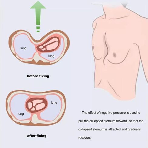 Pectus Excavatum Orthosis Brace - Pectus Excavatum Vacuum Bell,Pectus Excavatum Brace for Adults and Child(S-s) in Saudi Arabia