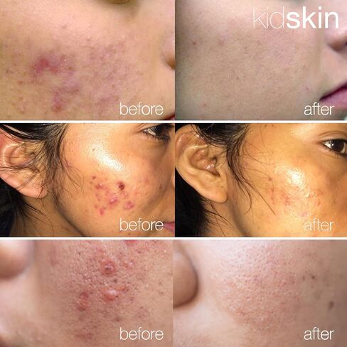 Kidskin T-Blast Facial Cleanser, Gentle Face Wash with Tea Tree Oil, Spot Skin Care for Kids and Teens, Non-Drying Natural Cleanser for Oily or Dry, Acne-Prone Skin, 150 ml 5.0 fl oz. in Saudi Arabia