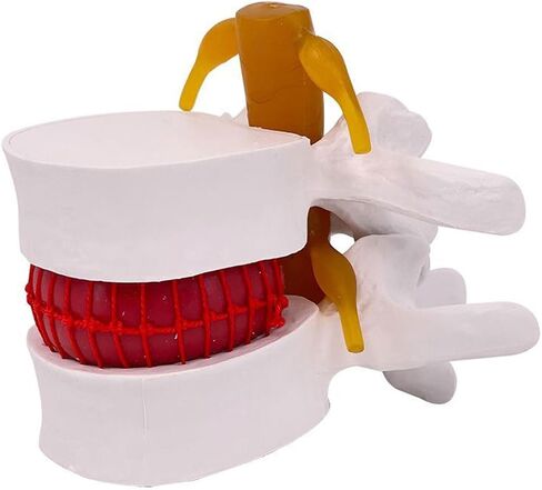 Human Anatomical Lumbar Disc Herniation Model, 1.5X Life-Size Herniated Lumbar Vertebrae Spine Model for Medical Teaching, Patient Education, Classroom Learning & Demonstration in Saudi Arabia
