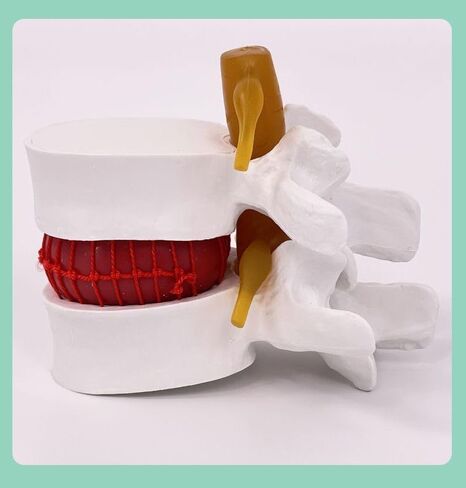 Human Anatomical Lumbar Disc Herniation Model, 1.5X Life-Size Herniated Lumbar Vertebrae Spine Model for Medical Teaching, Patient Education, Classroom Learning & Demonstration in Saudi Arabia