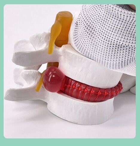 Human Anatomical Lumbar Disc Herniation Model, 1.5X Life-Size Herniated Lumbar Vertebrae Spine Model for Medical Teaching, Patient Education, Classroom Learning & Demonstration in Saudi Arabia