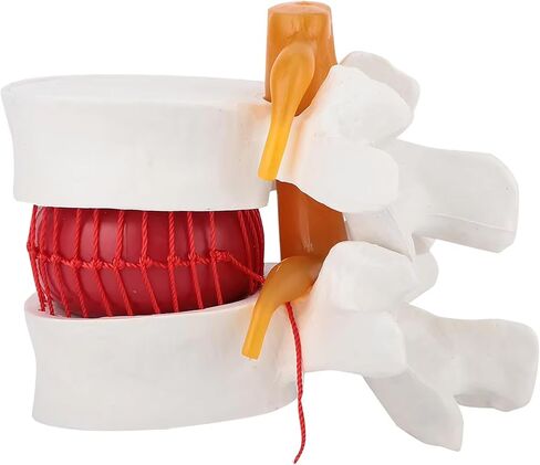 Human Lumbar Disc Herniation Model, 1.5 Times Durable and Lightweight Human Lumbar Disc Model, Visualized Anatomy of Lumbar Disc Herniation, Applied in Learning, Teaching, and Display in Saudi Arabia