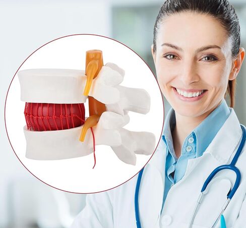 Human Lumbar Disc Herniation Model, 1.5 Times Durable and Lightweight Human Lumbar Disc Model, Visualized Anatomy of Lumbar Disc Herniation, Applied in Learning, Teaching, and Display in Saudi Arabia