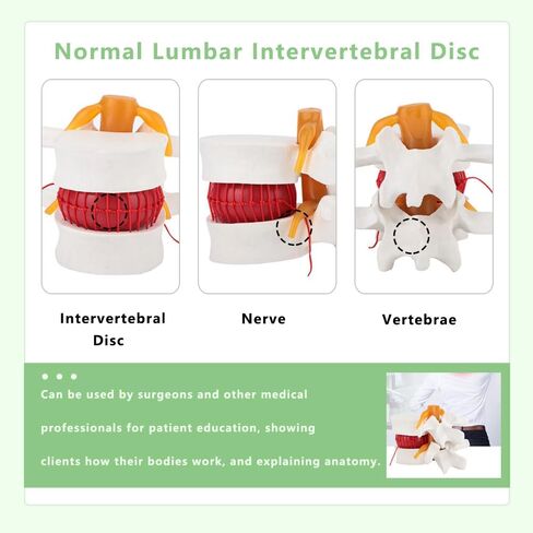 Human Lumbar Disc Herniation Model, 1.5 Times Durable and Lightweight Human Lumbar Disc Model, Visualized Anatomy of Lumbar Disc Herniation, Applied in Learning, Teaching, and Display in Saudi Arabia