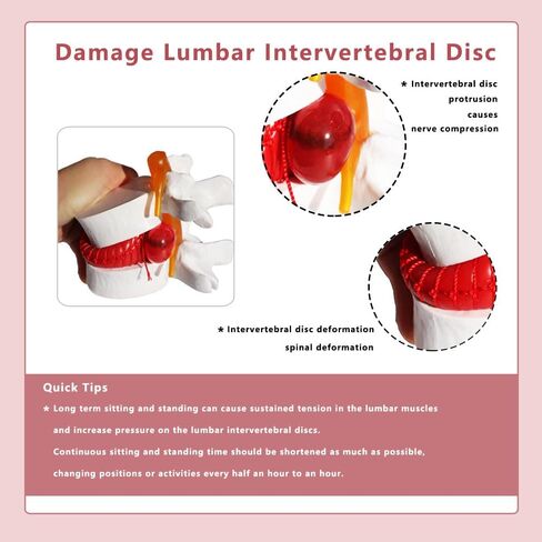 Human Lumbar Disc Herniation Model, 1.5 Times Durable and Lightweight Human Lumbar Disc Model, Visualized Anatomy of Lumbar Disc Herniation, Applied in Learning, Teaching, and Display in Saudi Arabia