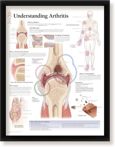 Understanding Arthritis Framed Medical Educational Poster Informational Diagram Doctors Office School Classroom 22x28 Inches in Kuwait