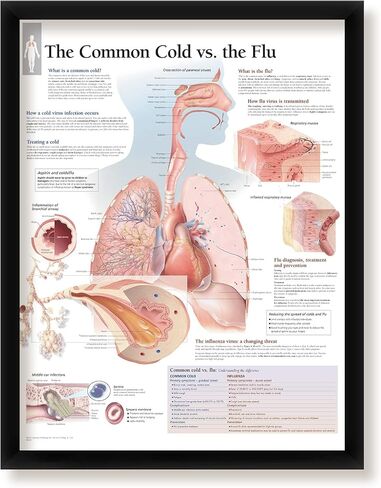 Understanding Arthritis Framed Medical Educational Poster Informational Diagram Doctors Office School Classroom 22x28 Inches in Kuwait