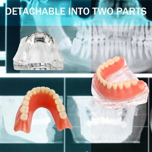 Dental Model Overdenture Transparent Dental Implants Model Detachable Model Lower Jaw Dental Teaching Model Suitable for Education and Study Silver in Saudi Arabia