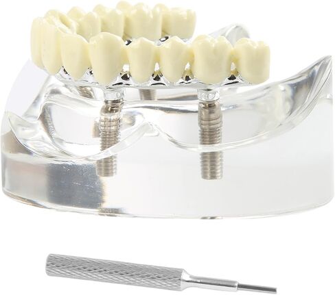 Dental Model Overdenture Transparent Dental Implants Model Detachable Model Lower Jaw Dental Teaching Model Suitable for Education and Study Silver in Saudi Arabia