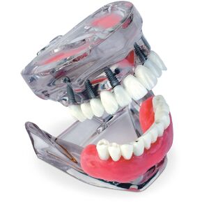 Practicon 4112178 Dual Arch Implant Model