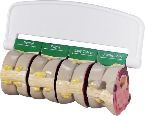 GPI Anatomicals - 4-Piece Colon Model, Replica of a Colon with Pathologies for Human Anatomy and Physiology Education, Anatomy Model for Doctor's Offices and Classrooms, Medical Learning Resources in Kuwait