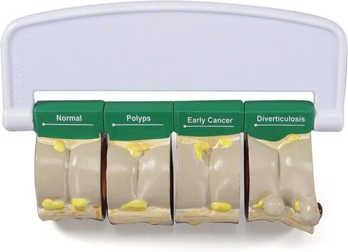GPI Anatomicals - 4-Piece Colon Model, Replica of a Colon with Pathologies for Human Anatomy and Physiology Education, Anatomy Model for Doctor's Offices and Classrooms, Medical Learning Resources in Kuwait