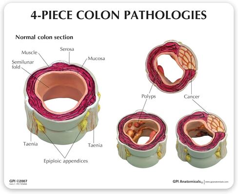 GPI Anatomicals - 4-Piece Colon Model, Replica of a Colon with Pathologies for Human Anatomy and Physiology Education, Anatomy Model for Doctor's Offices and Classrooms, Medical Learning Resources in Kuwait
