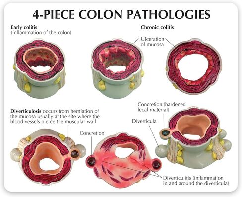 GPI Anatomicals - 4-Piece Colon Model, Replica of a Colon with Pathologies for Human Anatomy and Physiology Education, Anatomy Model for Doctor's Offices and Classrooms, Medical Learning Resources in Kuwait