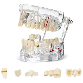 Outus Disease Teeth Model Dental Typodonts Implant Teeth Model with Removable Teeth Dentist Standard Tooth Pathological Demonstration for Christmas Education Dental Supplies (Pink,1 Pcs)