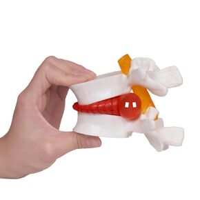 Human Anatomical Lumbar Disc Herniation Model, Portable Herniated Lumbar Vertebrae Disc, 1.5 Times Life Size Lumbar Spine Model for Teaching, Learning and Demonstrating