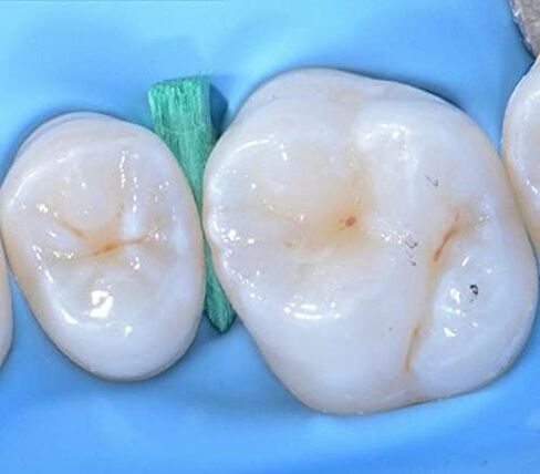 Wooden Wedges Dental, Teeth Interproximal Wedges Disposable Fixing Materials for Dental Restoration, Impregnated with Hemostatic Composition Dental Set 200pcs in Kuwait